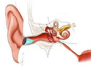 completely-in-canal hearing aid canal fitting CIC hearing aid